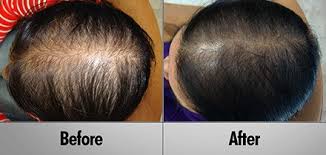 Clinical laser treatments for hair loss can cost thousands of dollars a year. Professional Laser Hair Therapy Clinically Proven 90 Effective