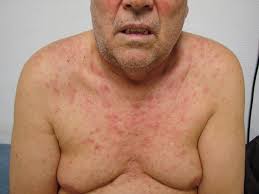 Image result for skin rash acute hiv infection