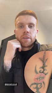 Tattoos gone scabby 😱😱😱 #tattoo #scabby #tattooremoval