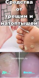 как избавиться от трещин на пятках с помощью перекиси Gorchica S Saharom Tvorit Chudesa Zdorove I Krasota Sovety Postila V 2020 G Zdorove Zdorove I Krasota Sovety