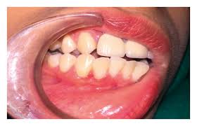 Image result for granuloma gum disease