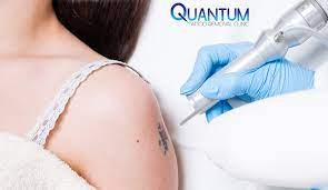 Clean slate tattoo removal at vein specialties. Quantum Tattoo Removal Clinic Quantumclinicau Twitter