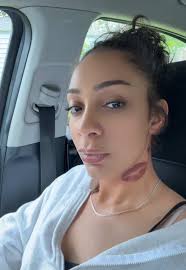 Laser Tattoo Removal Journey: Session Three Update