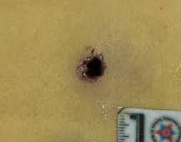 The remarkable response of the hospital and its staff, the victims and the broader community are outlined. Gunshot Wounds Forensic Pathology Article