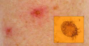 Tradisjonelt sender mikrofonene i hoveddelen av høreapparatene lyden ned i øret gjennom. Skabb Gir Utslett Og Kloe Lommelegen