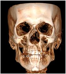 Facial Foramen Diagnostic and Surgical Role as Reference Points in  Asymmetries&mdash;Cone-Beam Computed Tomography Preliminary Study