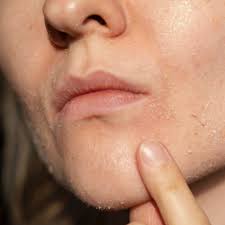 Image result for Dry Skin