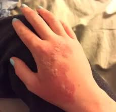 Image result for Photodermatitis