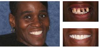 This results in dentures that look more natural in your mouth. Baton Rouge Dentures