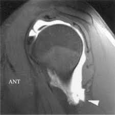 Discover more music, concerts, videos, and pictures with the largest catalogue online at last.fm. Arthroscopic Repair Of A Posterior Humeral Avulsion Of The Inferior Glenohumeral Ligament Hagl Lesion Arthroscopy