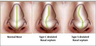 Check spelling or type a new query. Deviatia De Sept Nazal Alerta Orl