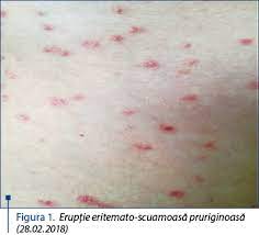 Alergii cutanate, alergii oculare, puruit, eruptie cutanata, eritem, angioedem, pleoape cazute, alergii piele. Artrita Cu Leziuni Cutanate Probleme De Diagnostic