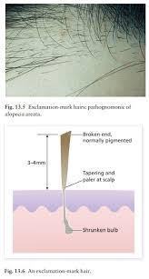 Maybe you would like to learn more about one of these? Alopecia Areata