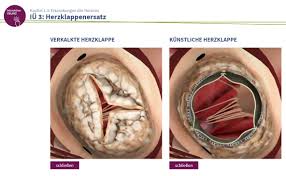 الوسم Herzklappenersatz على تويتر