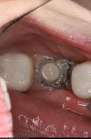 Should A Tooth That Is Broken To The Gumline Be Fixed