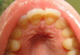 People who have bulimia go through periods where they eat a lot of food in a very short. Bulimia Nervosa Wikipedia