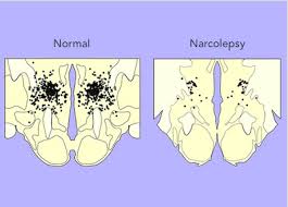 Image result for Narcolepsy