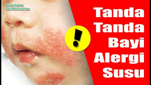Apa beza bayi cirit birit dan najis bayi yang normal? Gejala Dan Tanda Tanda Alergi Susu Anak Anda