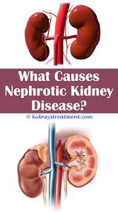 Polysistic Kidney Disease Kidney Disease Symptoms Kidney Disease Recipes Kidney Disease Stages