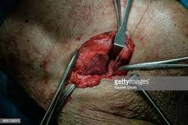 Implant Of Polypropylene Mesh For Hernia Repair Hernia Repair Repair Implants