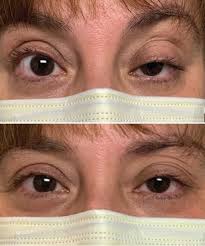 Image result for Ice Pack Test