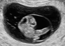 We did not find results for: Early Pregnancy Complications The Gynaecology Ultrasound Centre