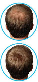 Stem cells are undifferentiated cells which can specialise into any cell in the body therefore useful for any growth and repair required. 13 Hair Loss Products Ideas Hair Loss Healthy Hair Hair