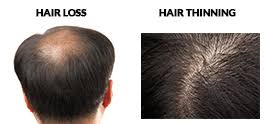 Some factors that can contribute to or lead to thinning hair or baldness are genes, untreated medical conditions, poor nutrition, vitamin deficiency, exposure to harmful ultraviolet (uv) rays and living in a highly. Difference Between Hair Loss And Hair Thinning