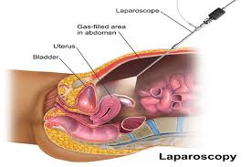 Sarcina extrauterina (ectopica) reprezinta implantarea anormala a zigotului (produsului de conceptie), adica in afara cavitatii uterine. Cum Se Trateaza Sarcina Extrauterina Totul Despre Sarcina