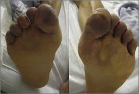 Purpura on the torso and back/face of a child. Purpura Fulminans Icd 10