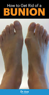 How To Get Rid Of A Bunion Bunion Remedies Get Rid Of Bunions Bunion Treatment