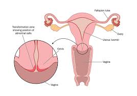 How serious is my cancer?€€ if you have cervical cancer, the doctor will want to find out how far it has spread. Colposcopy London Cervical Smear Test London Cervical Cancer Treatment
