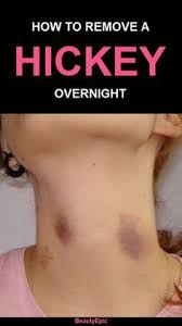 Top 10 Easy Ways To Get Rid Of A Hickey Overnight Hickeys How To Hide Hickeys Getting Rid Of Hemorrhoids