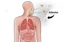 Prognosis, symptoms and treatment options vary by mesothelioma type. Peritoneal Mesothelioma Treatment Prognosis Diagnosis