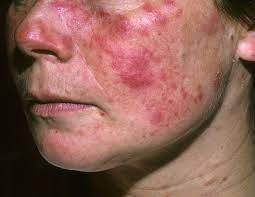 As an autoimmune disease, lupus occurs when your immune system attacks healthy tissue in your body. Igg Autoantibody Profile Examined In Established Systemic Lupus Erythematosus Rheumatology Advisor
