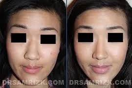 Ethnic Rhinoplasty NYC