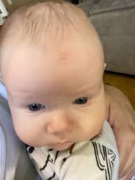 Motorcycle accident without helmet