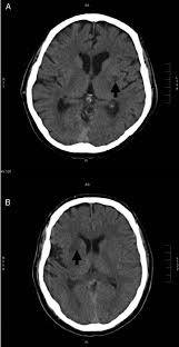 Assessment | biopsychology | comparative | cognitive | developmental | language | individual differences | personality | philosophy | social | methods | statistics | clinical | educational | industrial | professional items | world psychology |. A Small Infarct Within The Lentiform Nucleus After Successful Download Scientific Diagram