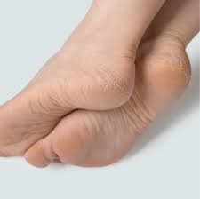 Control the Cracks: How to Deal with Dry Feet