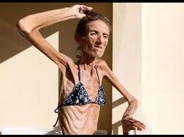 Skinniest person in the world. Skinniest Person In The World 55 Lbs Youtube
