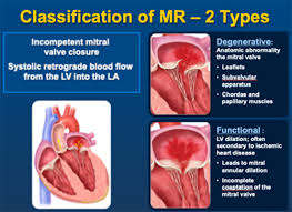 Mitral regurgitation is associated with cardiac malformation and can occur at any age, both in adults and in children. Mitraclip Procedure