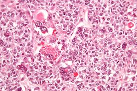 Many doctors use the risk of malignancy index (rmi) either alone or combined with subjective assessment and ultrasound findings to help sort out ovarian masses. Granulosa Cell Tumour Wikipedia