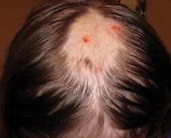 Image result for Hair Pull Test