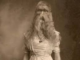 Image result for Hypertrichosis
