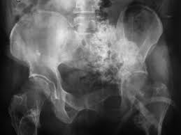 Image result for Chondrosarcoma