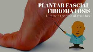 Sometimes this can produce pain that extends down to the toes. Plantar Fascial Fibromatosis Cause Symptoms Treatment