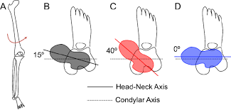 Image result for Femoral Retroversion
