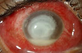 Résultat de recherche d'images pour "eye infection"