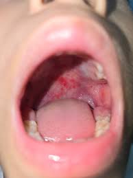 Image result for Hand foot and mouth disease HFMD roof of mouth