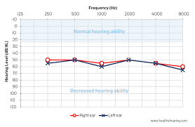 how to read an audiogram